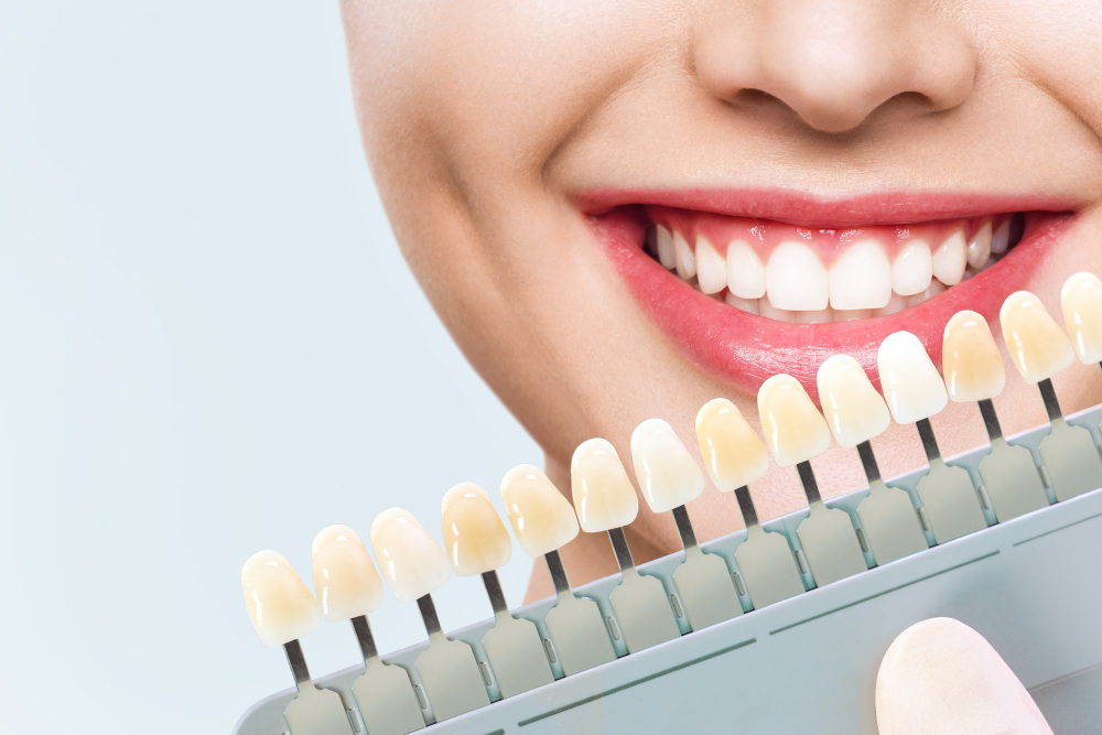 Dental Fillings - Veneers for a Radiant Smile