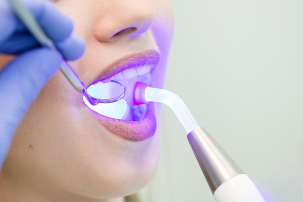 Laser Dentistry in San Jose