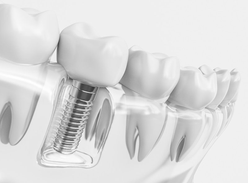 Is Teeth Whitening Safe?