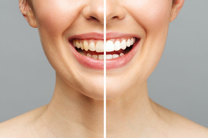 Is Teeth Whitening Safe?