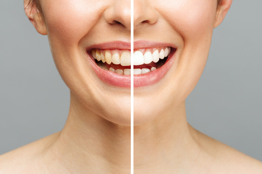 Professional Teeth Whitening in San Jose