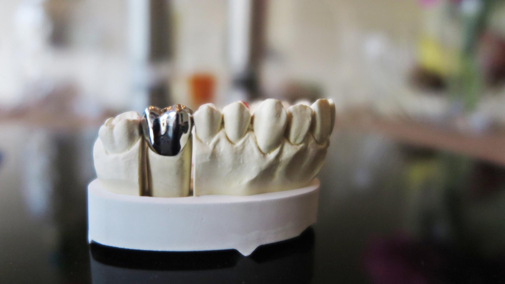 Types of Crowns for Teeth
